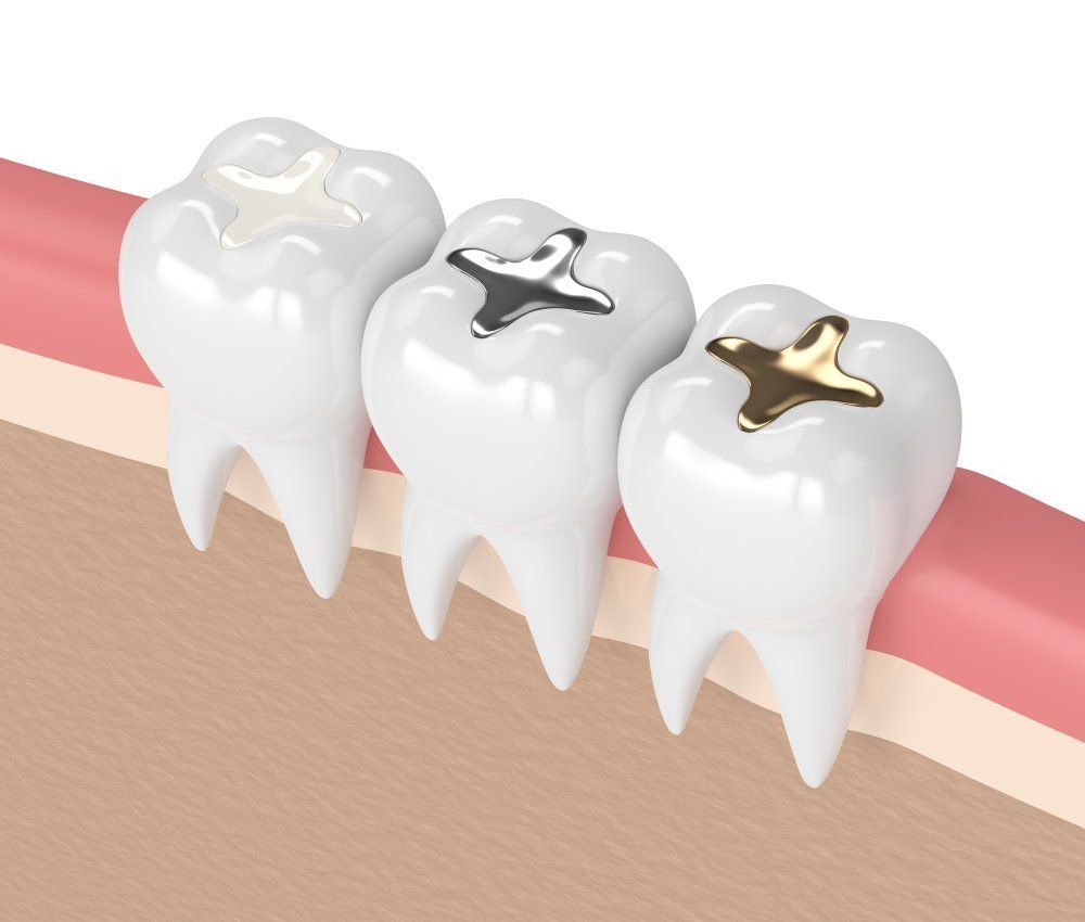 Three teeth with fillings in a dental illustration; silver, gold, and white fillings.