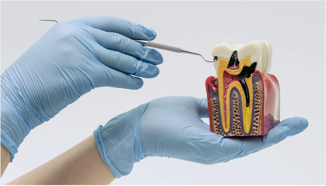 Hands in blue gloves holding a dental tool near a model of a tooth with cavities.