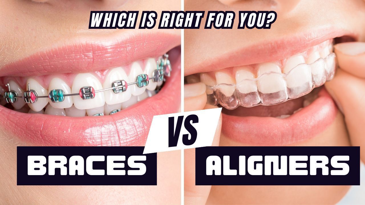 Comparison of traditional metal braces and clear Invisalign aligners in a professional dental setting.