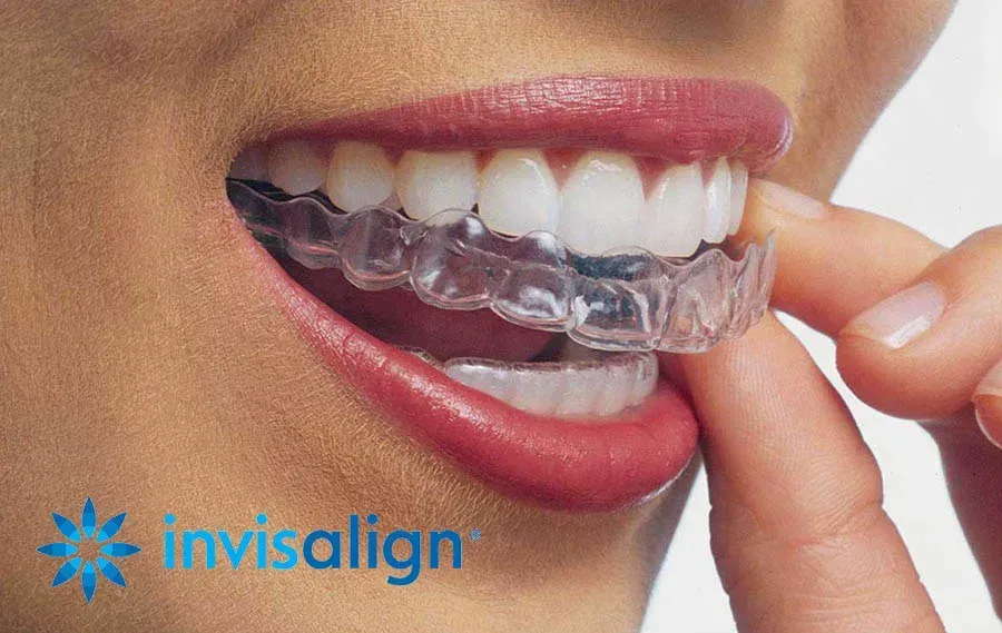 Person putting in clear Invisalign aligners, close-up of mouth and hand.
