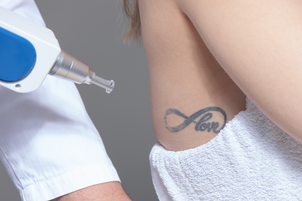 A woman is getting a tattoo removed from her arm.