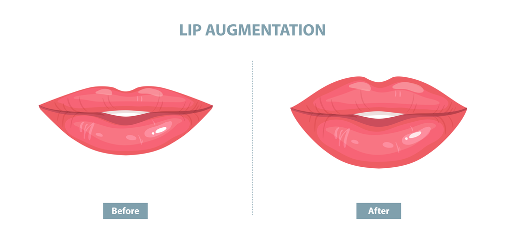 A before and after picture of a lip augmentation procedure.