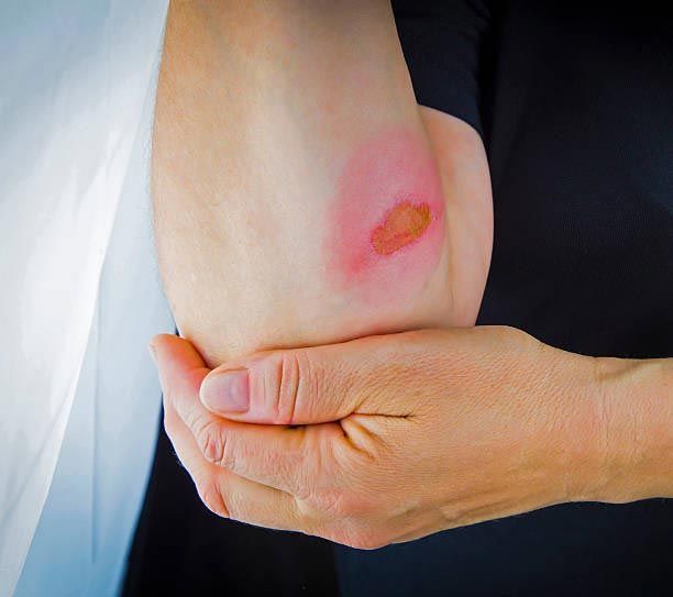 Arm with a burn on the elbow, held by the other hand. The burn is red and blistered.