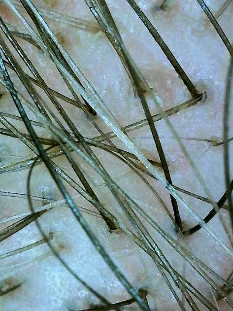 Primer plano de vellos oscuros dispersos sobre piel pálida con poros visibles y textura fina.