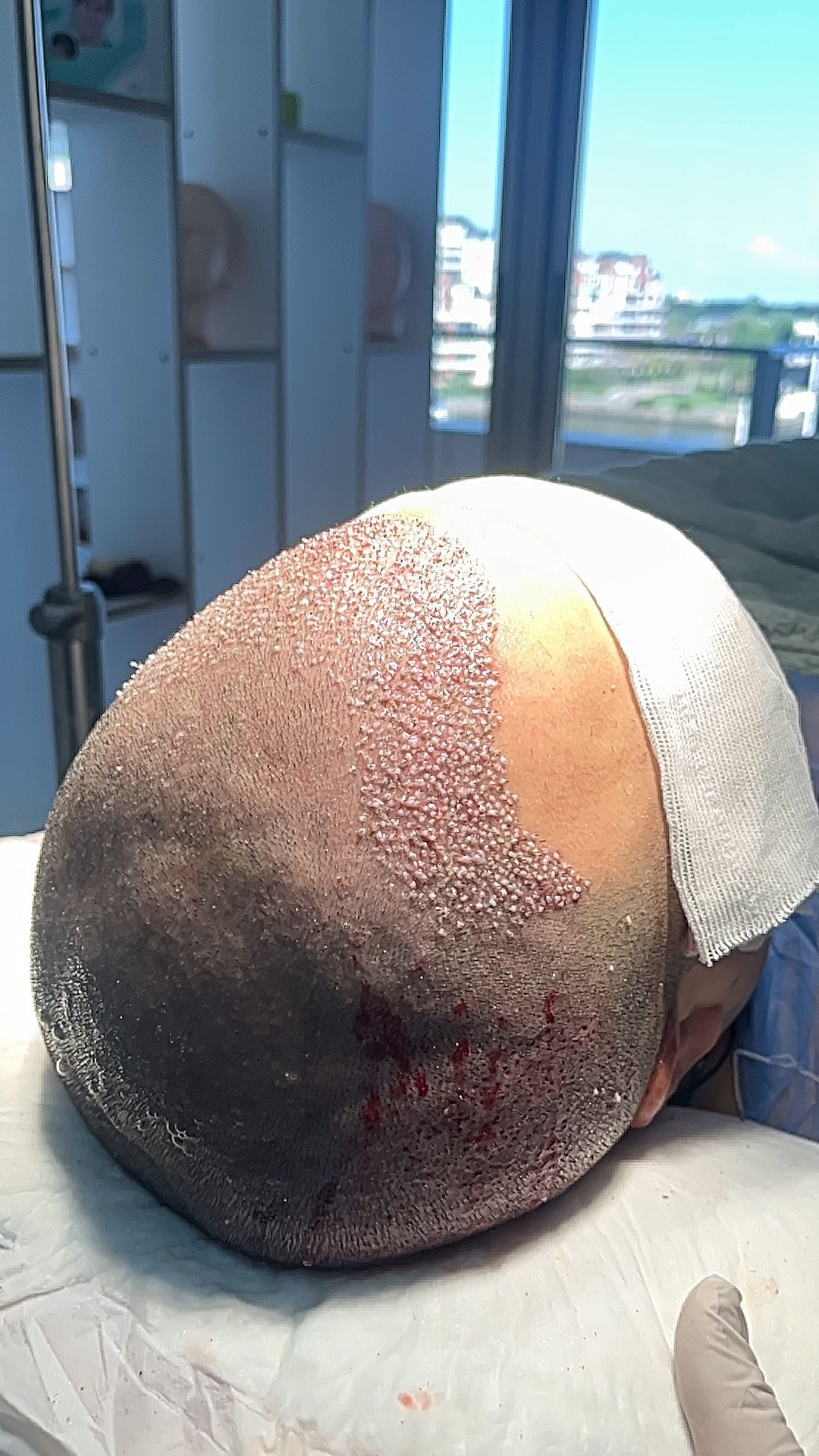 Cuero cabelludo gravemente quemado con grandes áreas injertadas y vendadas cerca de una ventana de hospital.