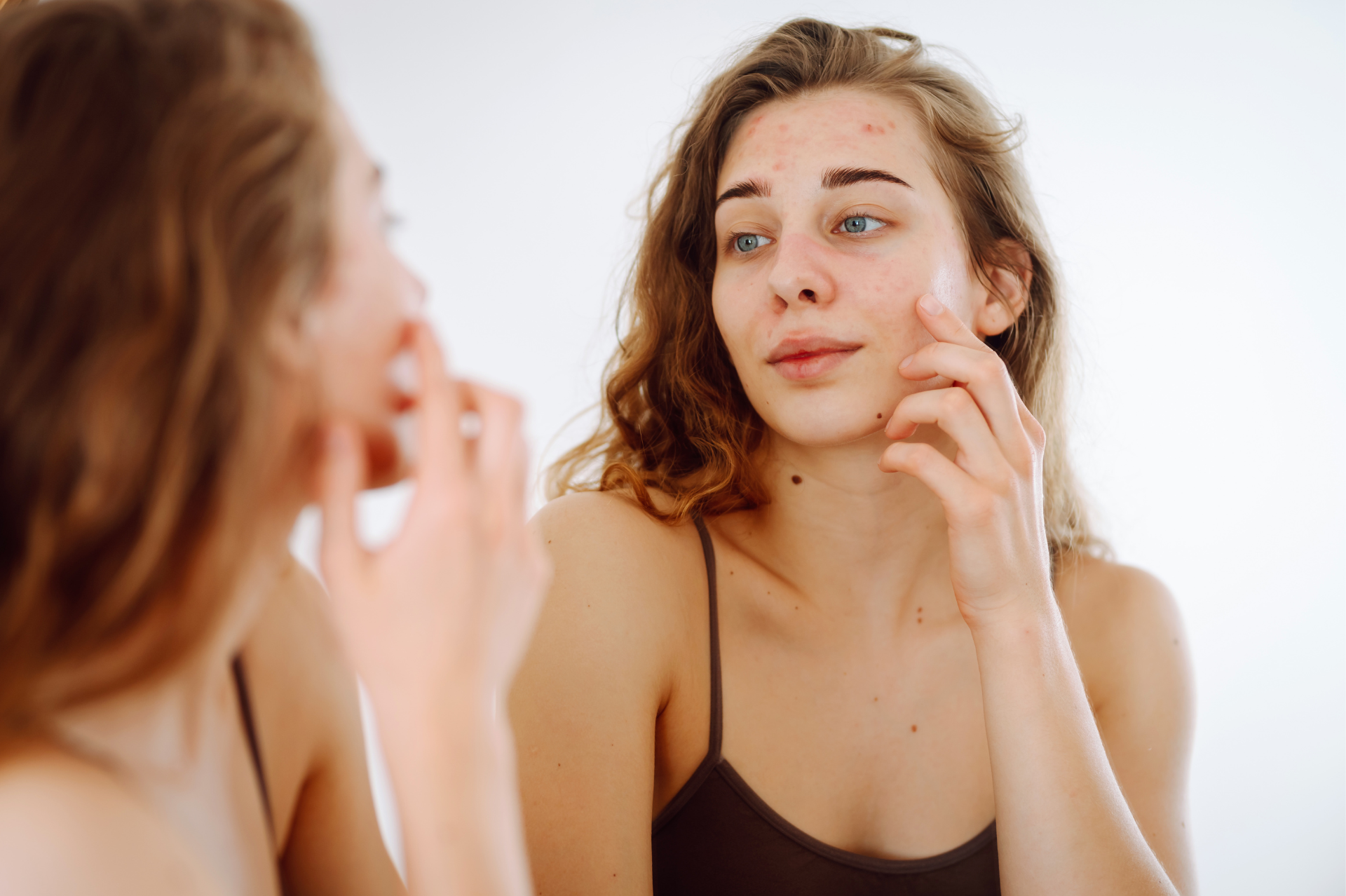 acne treatment