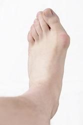 A close up of a person 's foot with a large bump on it.