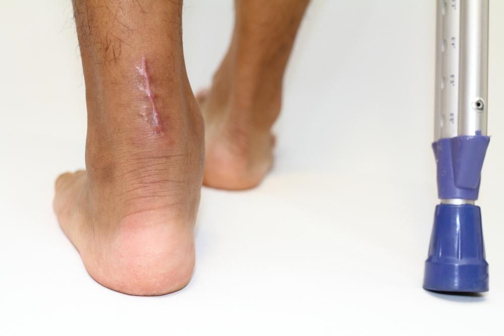 A person with a surgical scar on their ankle is walking with crutches.