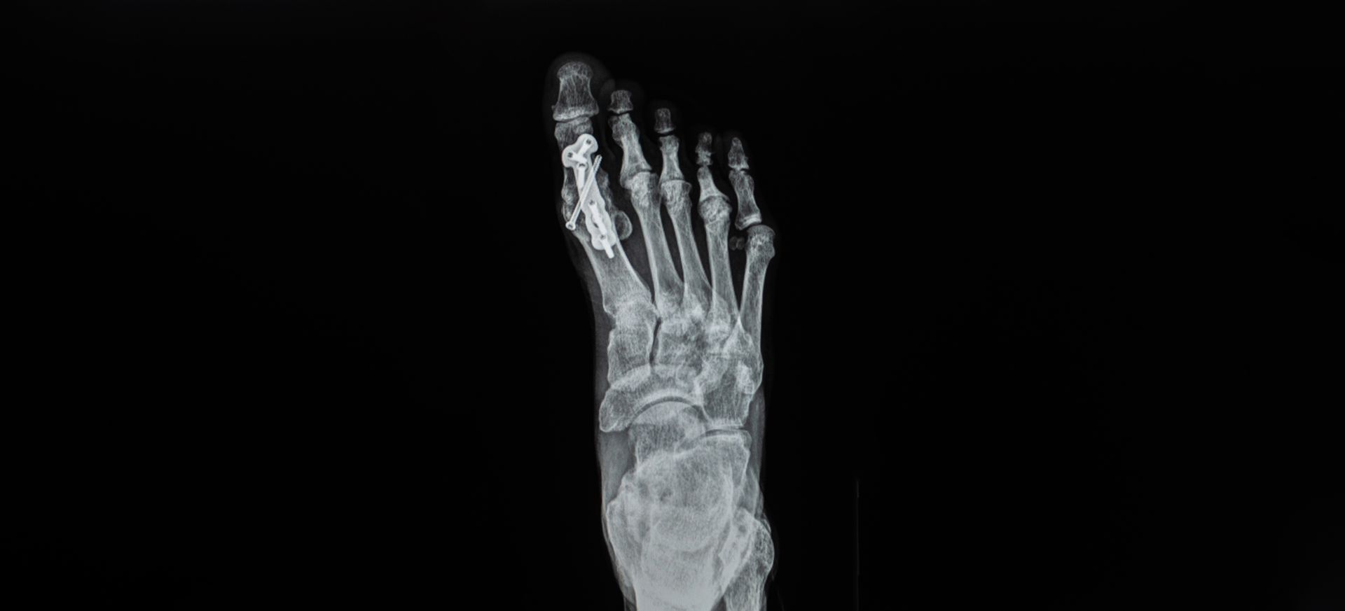 An x-ray of a foot on a black background shows the bones of the foot.