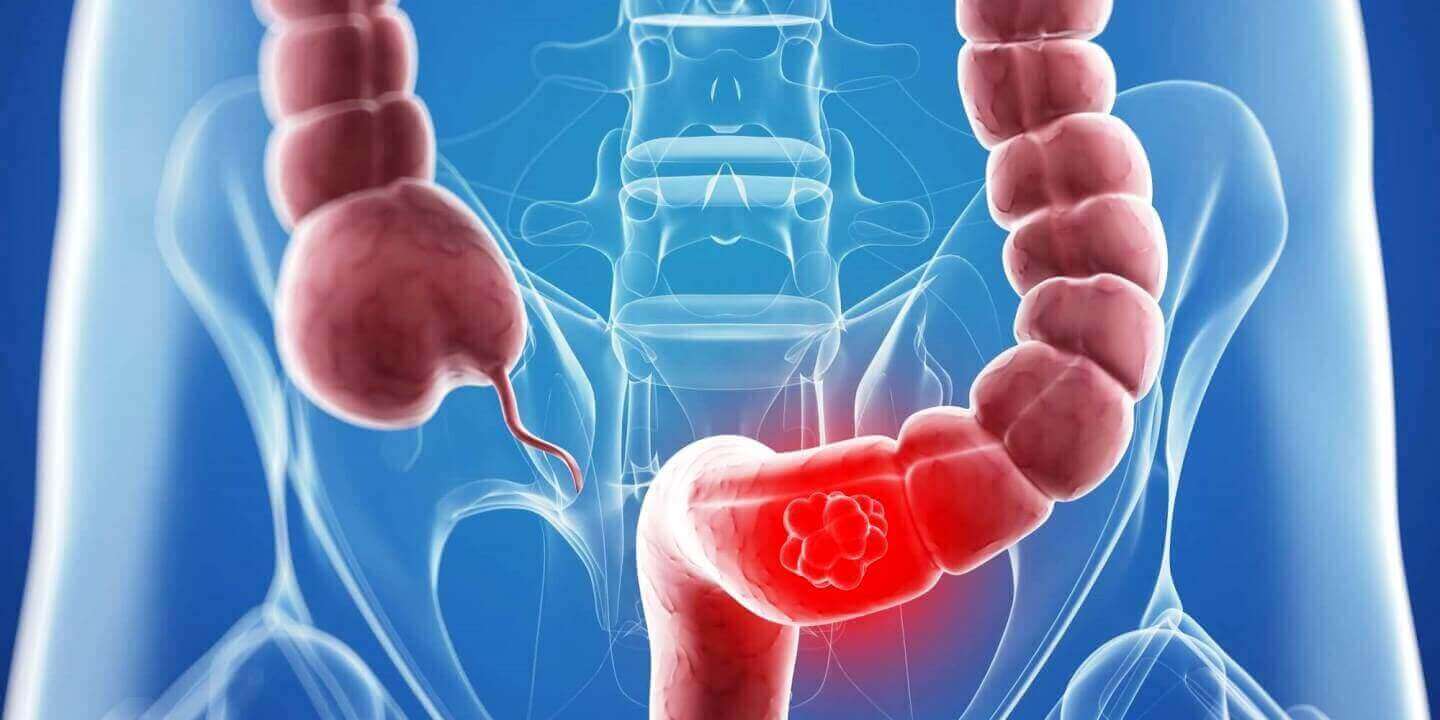 DR. MARCO VINICIO PEREZ MARISCAL - expertos en enfermedades de colon