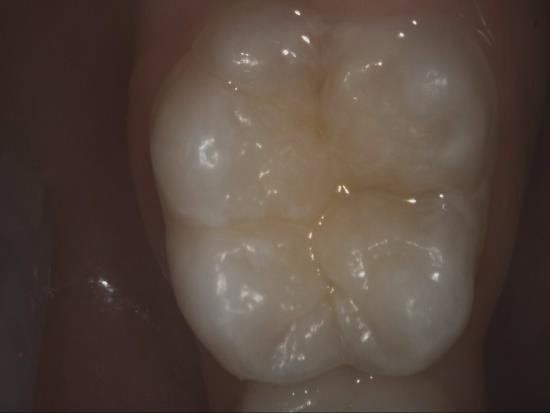 Molare prima della sigillatura