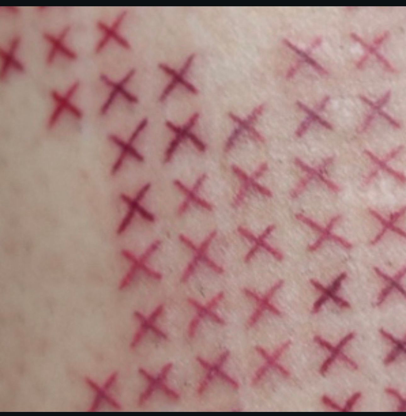 A close up of a person 's skin with red crosses drawn on it