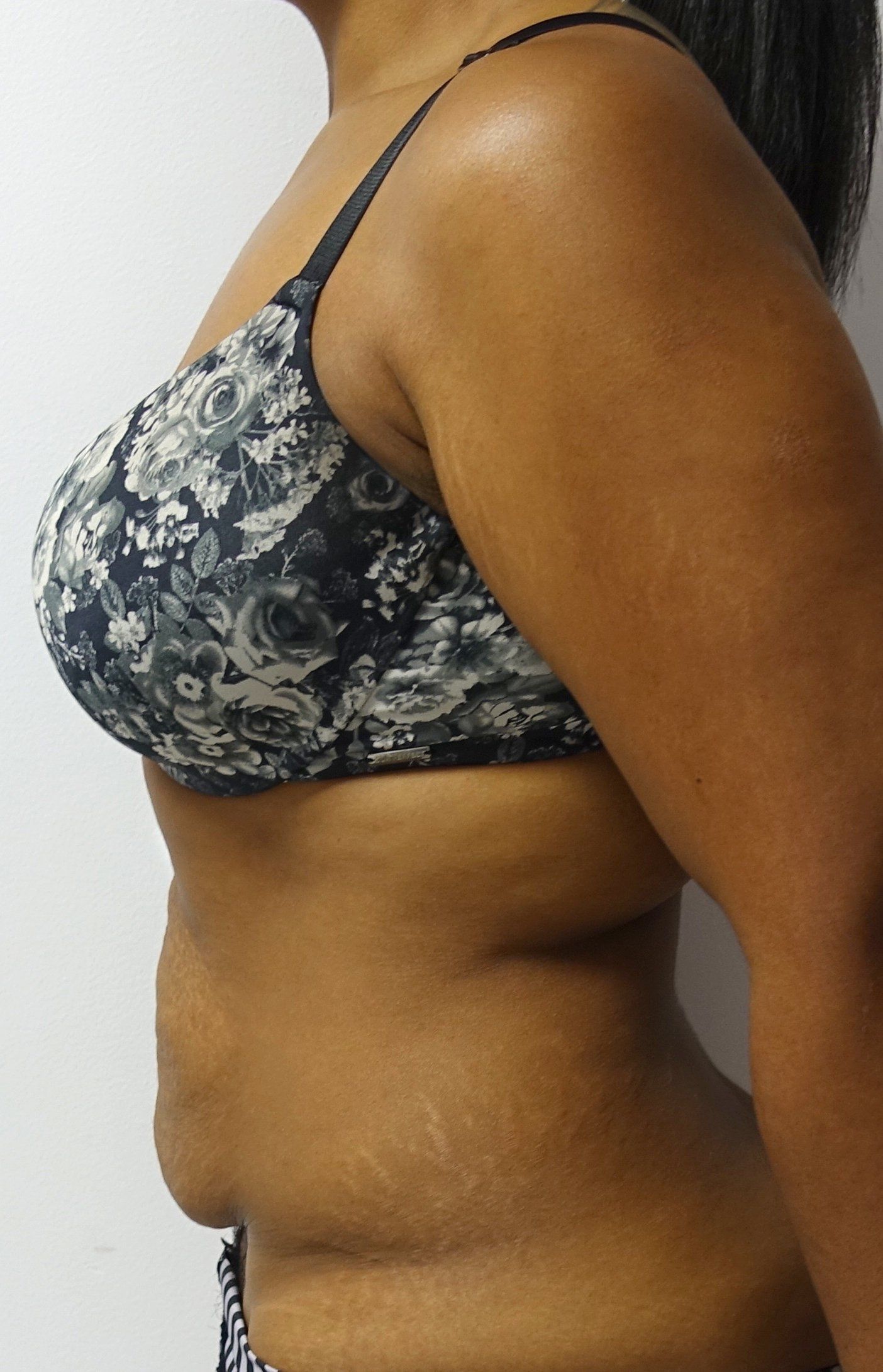 Abdominoplasty cropped 2