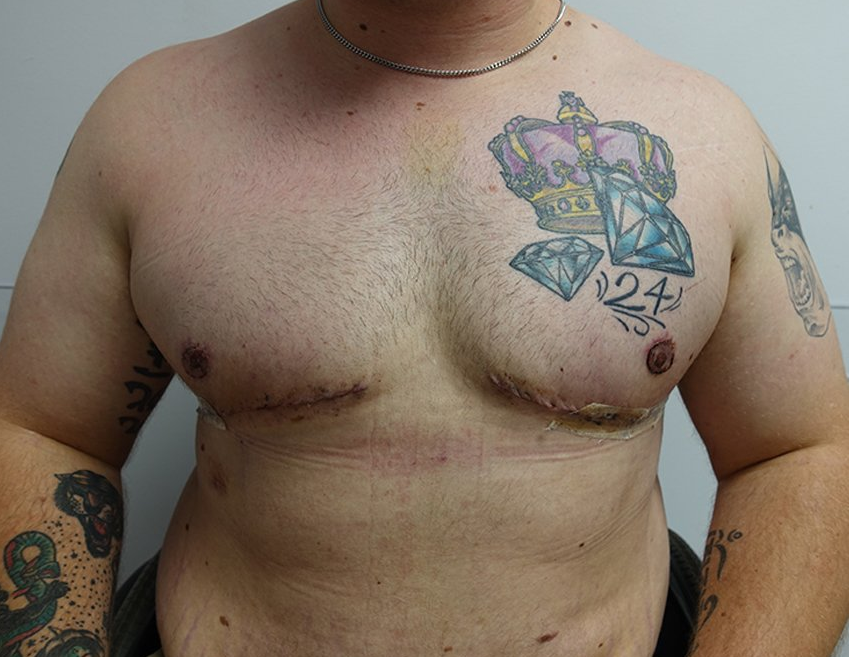 Gynecomastia cropped 3