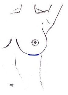 Breast Augmentation - IMF incision