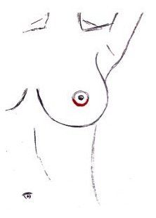 Breast Augmentation - Periareolar Incision