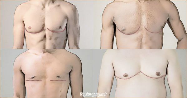 Gender Affirmation Surgery in Connecticut Chandler Plastic Surgery