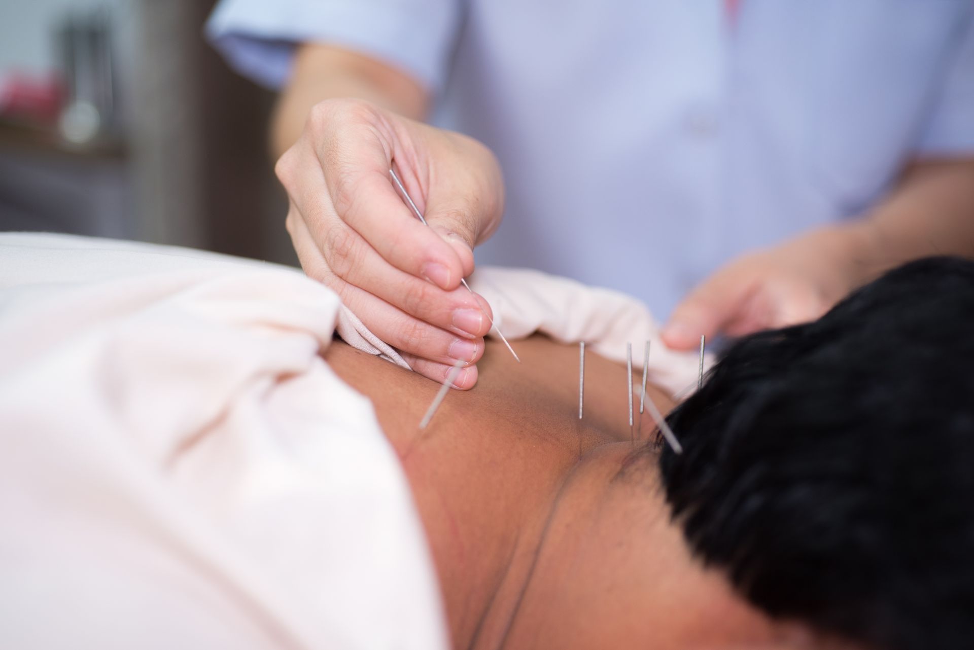 A person is getting acupuncture on their back.