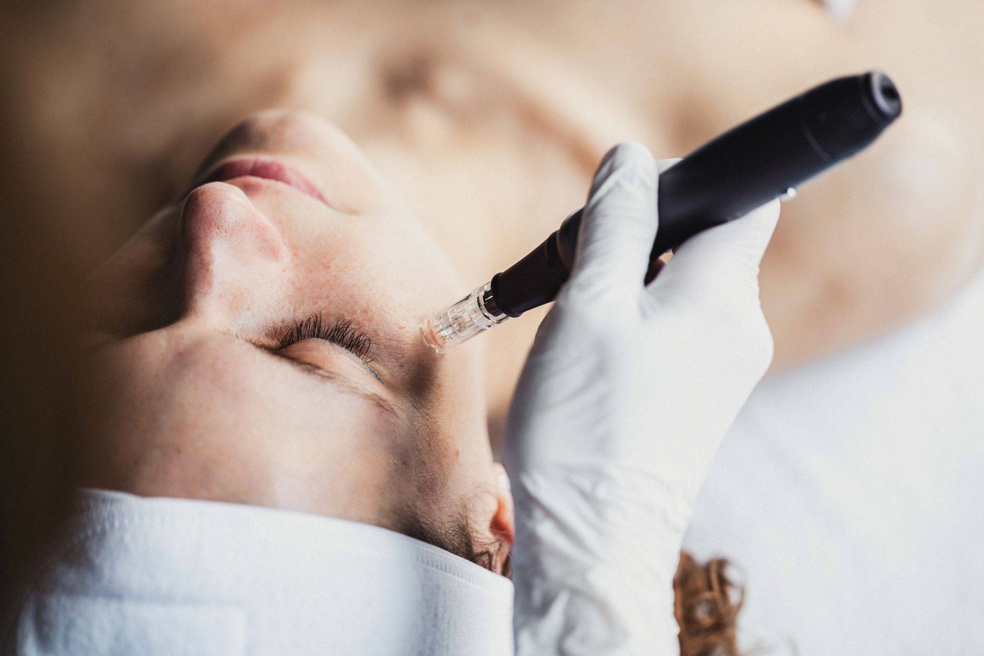 Persona sottoposta a trattamento di microneedling facciale, pelle trattata con un dispositivo portatile, primo piano.