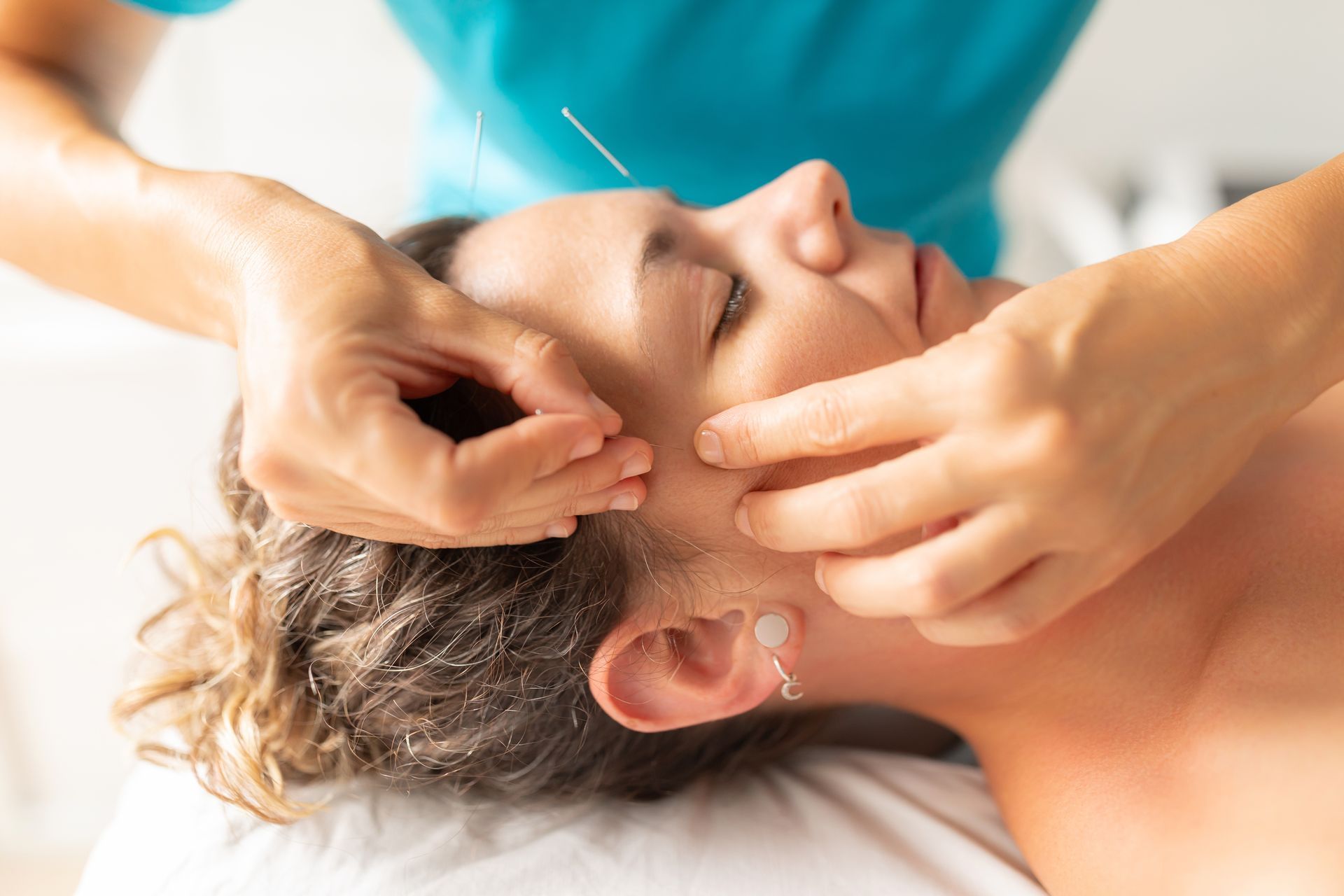 Close-up of a person receiving acupuncture on the face in a spa setting
