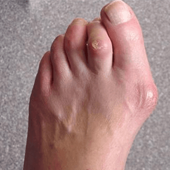 Hammer toe with corn and bunion