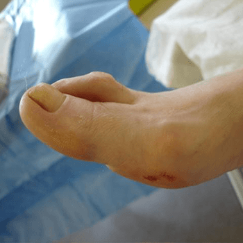 Hammer toe - side view