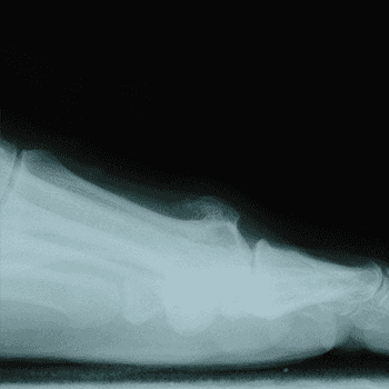Side view of arthritic joint