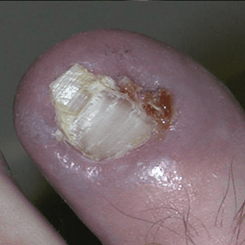 Painful Toe Nail
