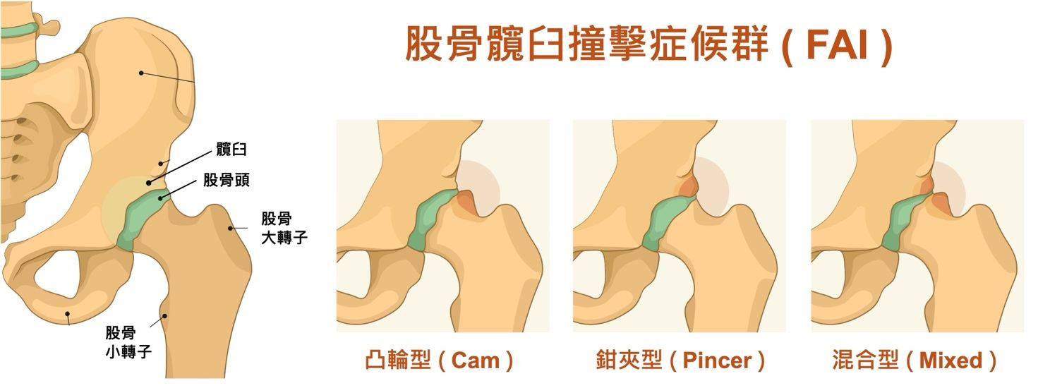 股骨髖臼撞擊症候群（FAI）
