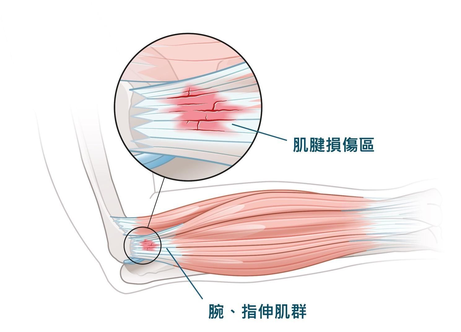 肌腱損傷區