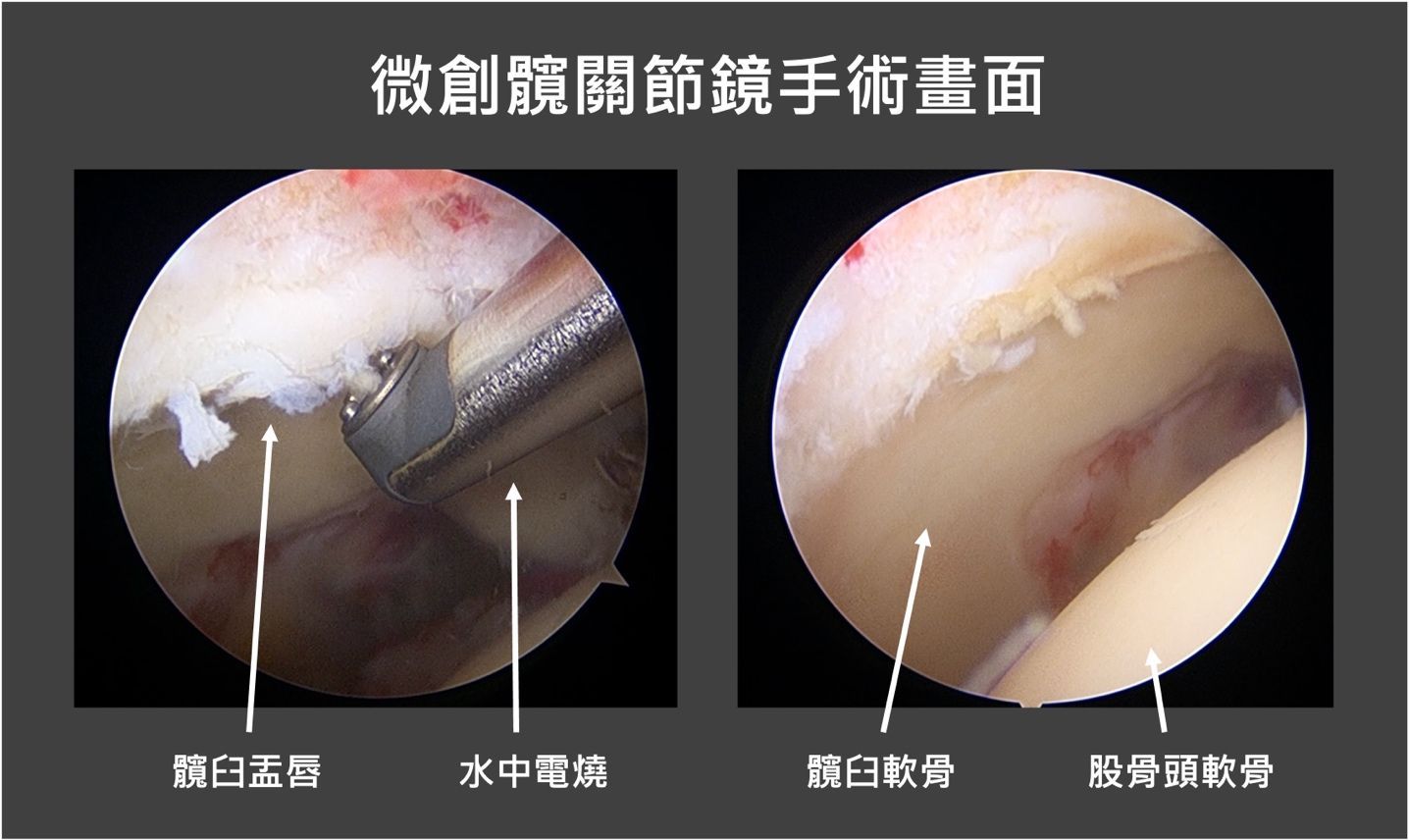 微創髖關節鏡手術畫面