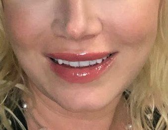 filler dissolver videos