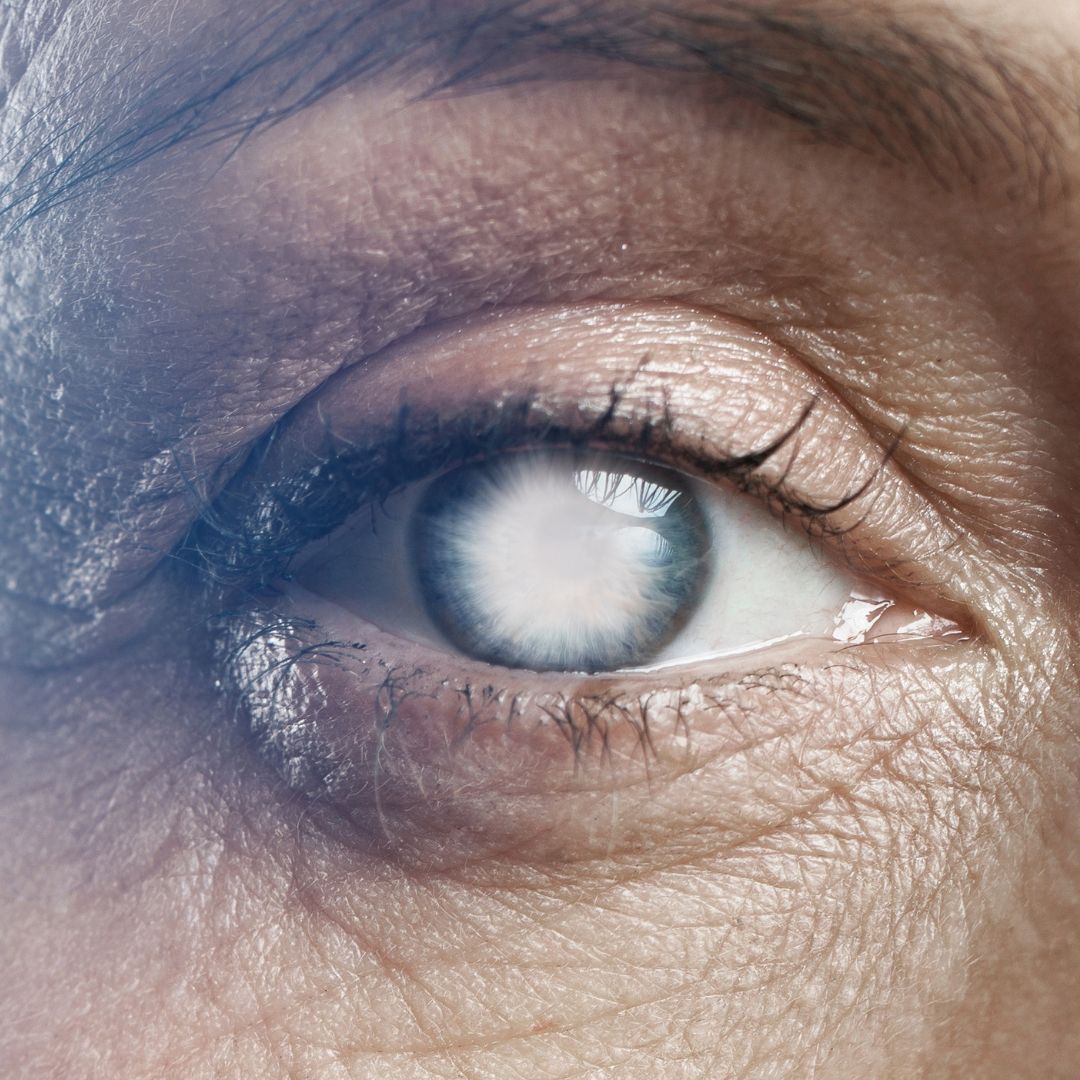 Cataract Treatment