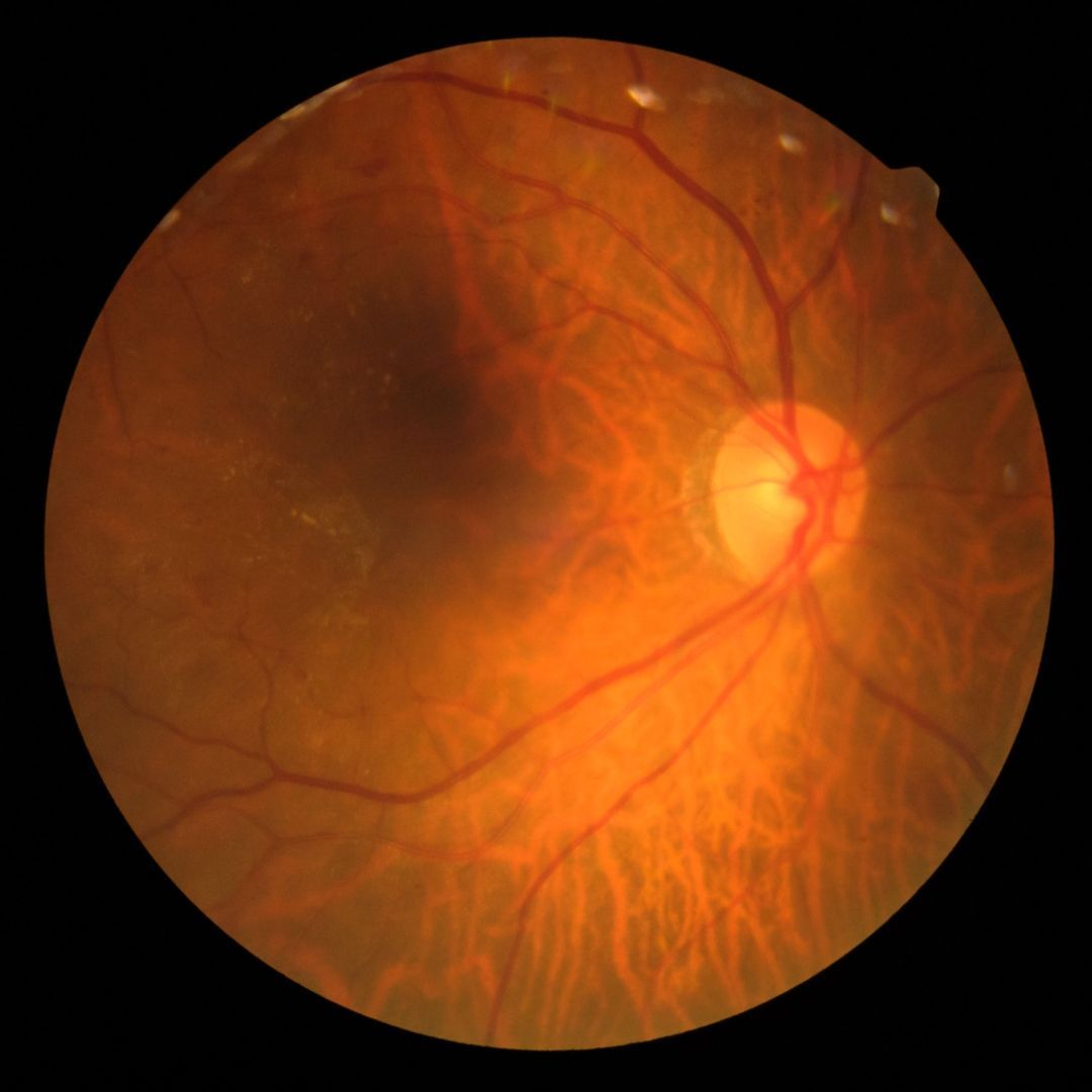 Diabetic Retinopathy
