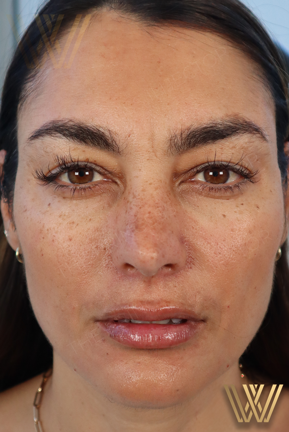 After photo of Client 3, highlighting the tailored masterpiece of MK Beautification by Windermere Medical Spa, showcasing the structure of filters and celebrity glow-up.