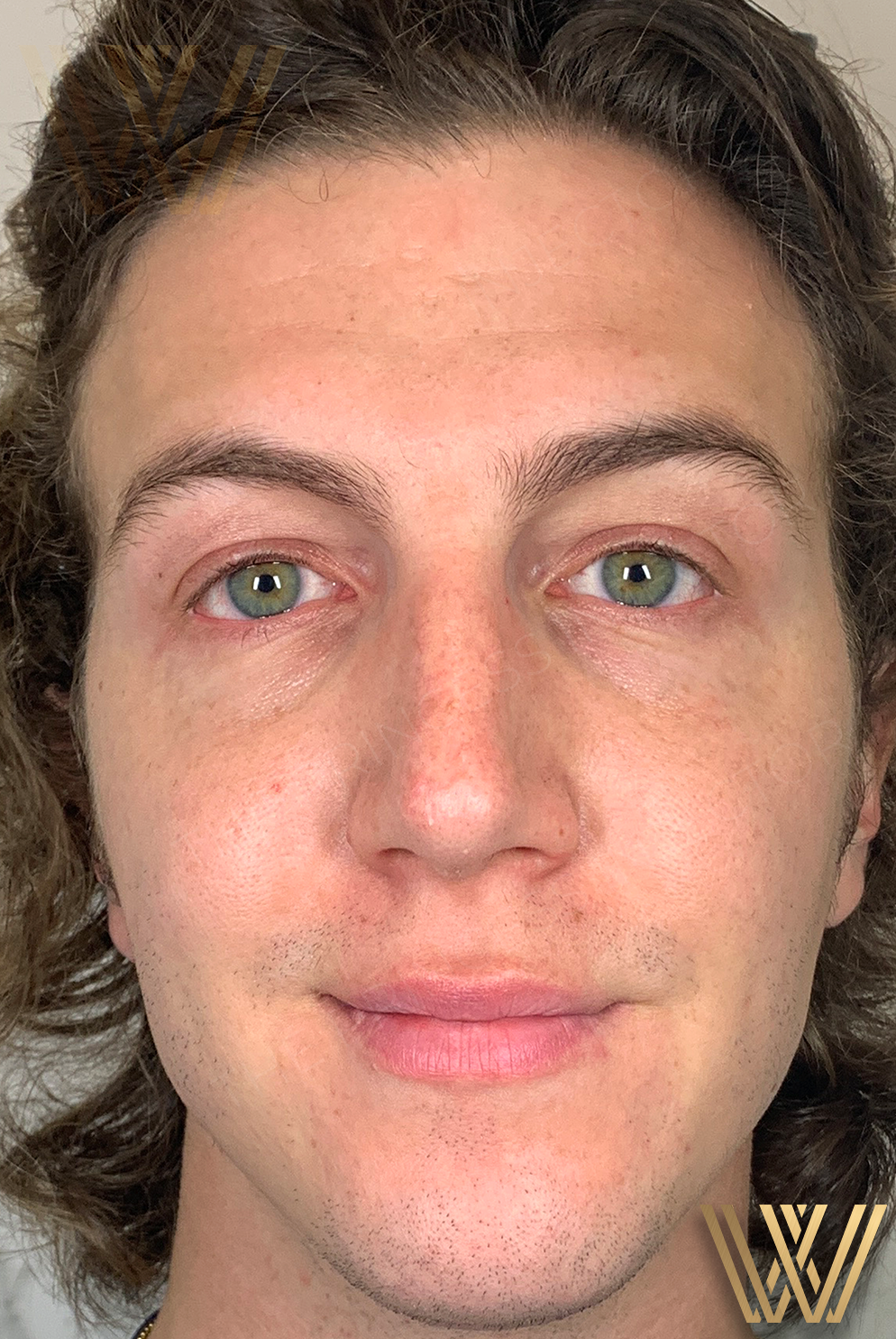 After photo showcasing the remarkable Sculptra results of a young man treated at Windermere Medical Spa & Laser Institute, top Sculptra provider in Orlando, FL