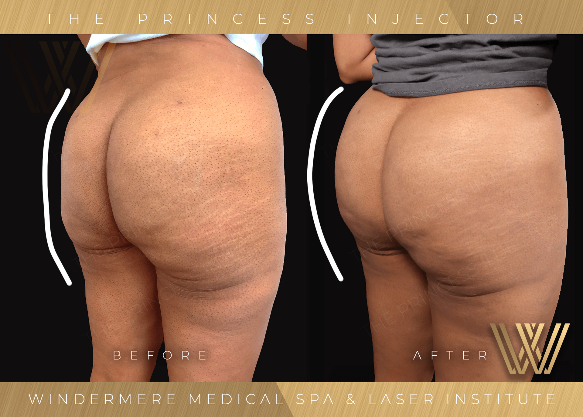 Before and after image showcasing the transformative results of a Sculptra Butt Lift treatment at Windermere Medical Spa & Laser Institute, displaying enhanced contours, lift, and improved skin texture.