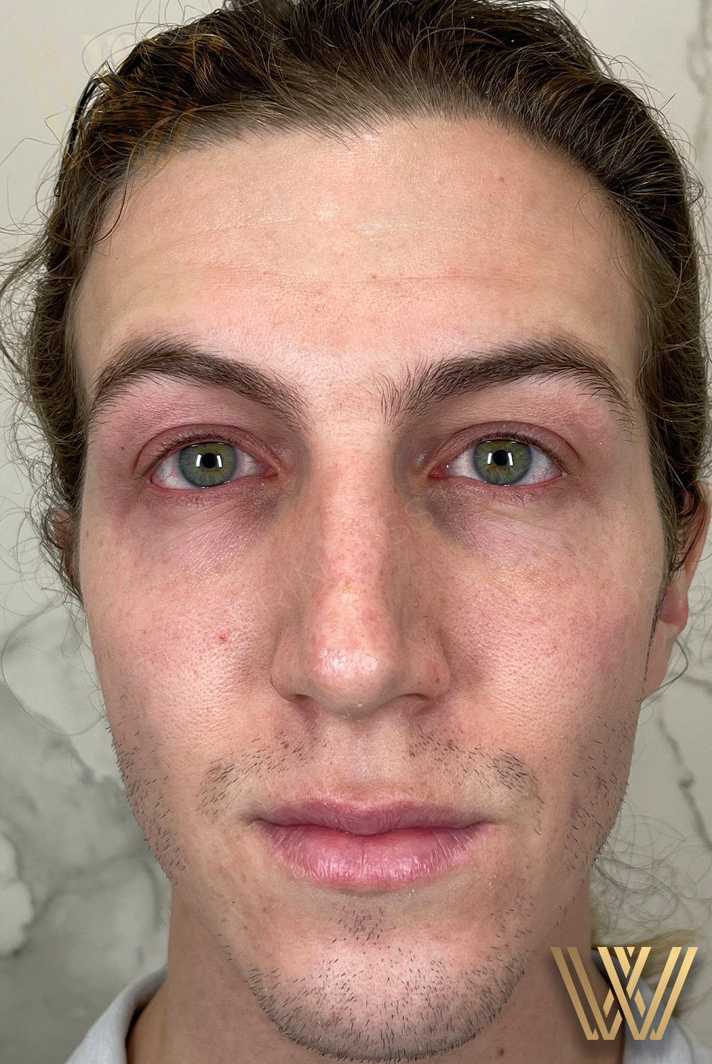Before photo of a young man prior to receiving transformative Sculptra treatment at Windermere Medical Spa & Laser Institute, leading Sculptra provider in Orlando, FL