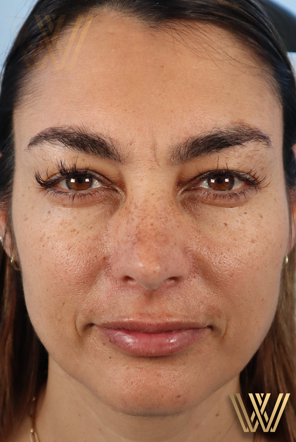Client 3's face before Windermere Medical Spa's MK Beautification, the ultimate filler glow-up in Orlando.