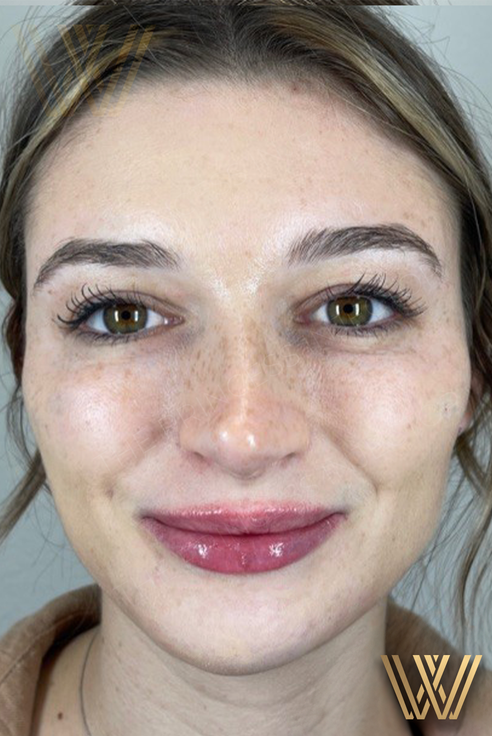 Transformed face of Client 4, thanks to the meticulous MK Beautification service offered at Windermere Medical Spa in Orlando, revealing airbrush-like contours and enhanced natural beauty.