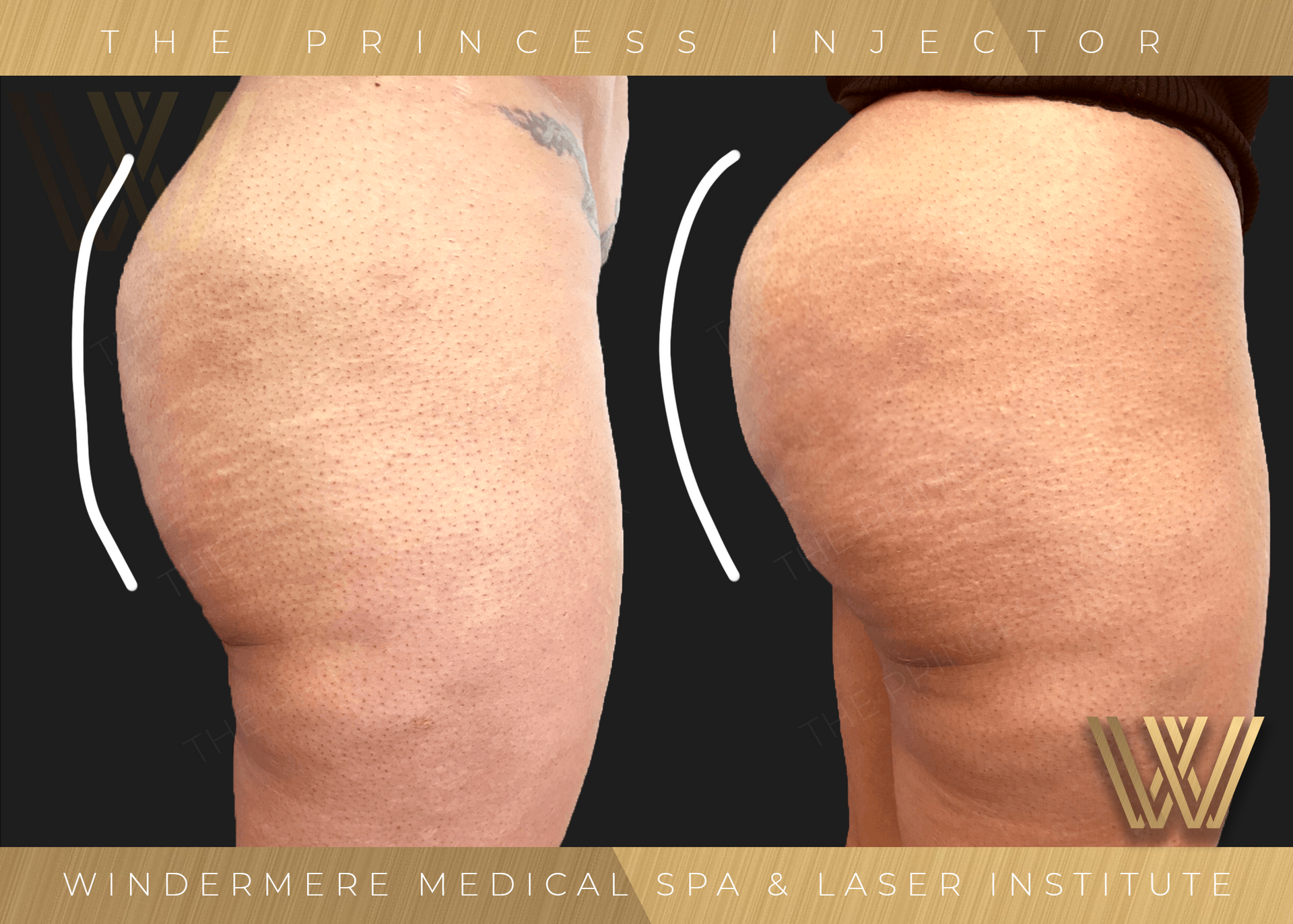 Comparison of pre-treatment and post-treatment outcomes following Sculptra Butt Lift at Windermere Medical Spa & Laser Institute, highlighting noticeable lift, contour refinement, and skin texture enhancement