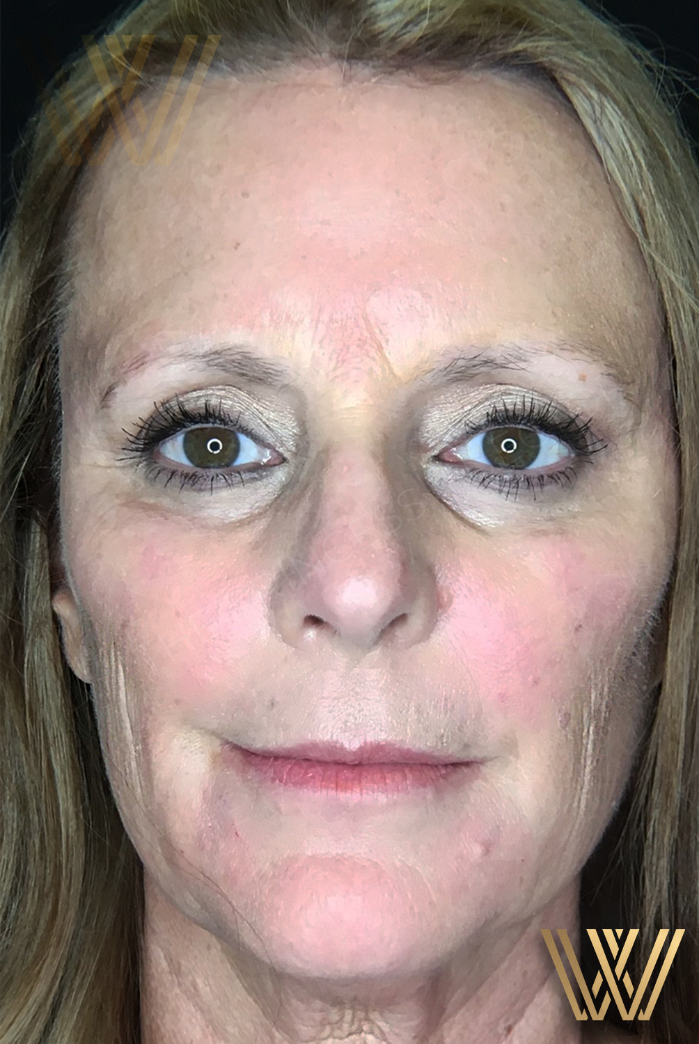 Middle-aged woman before undergoing Sculptra treatment at Windermere Medical Spa & Laser Institute in Orlando, FL, showing signs of aging.