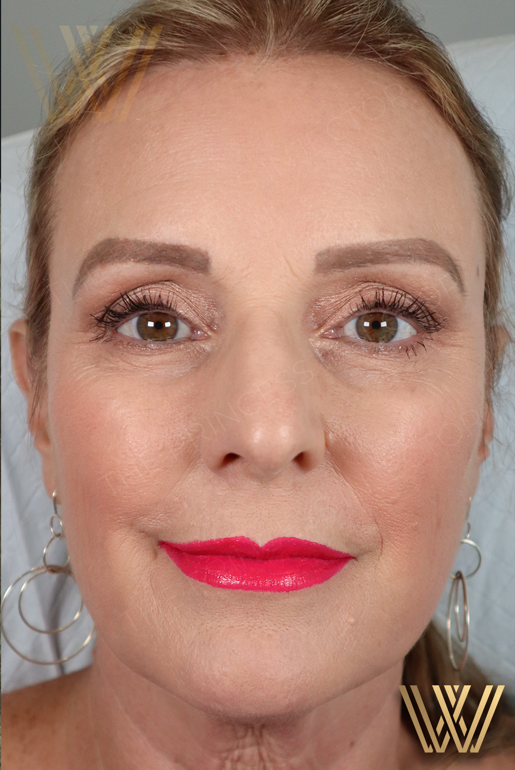 Stunning transformation of a middle-aged woman looking 10 years younger after Sculptra treatment by Windermere's experienced Princess Injectors in Orlando, FL.