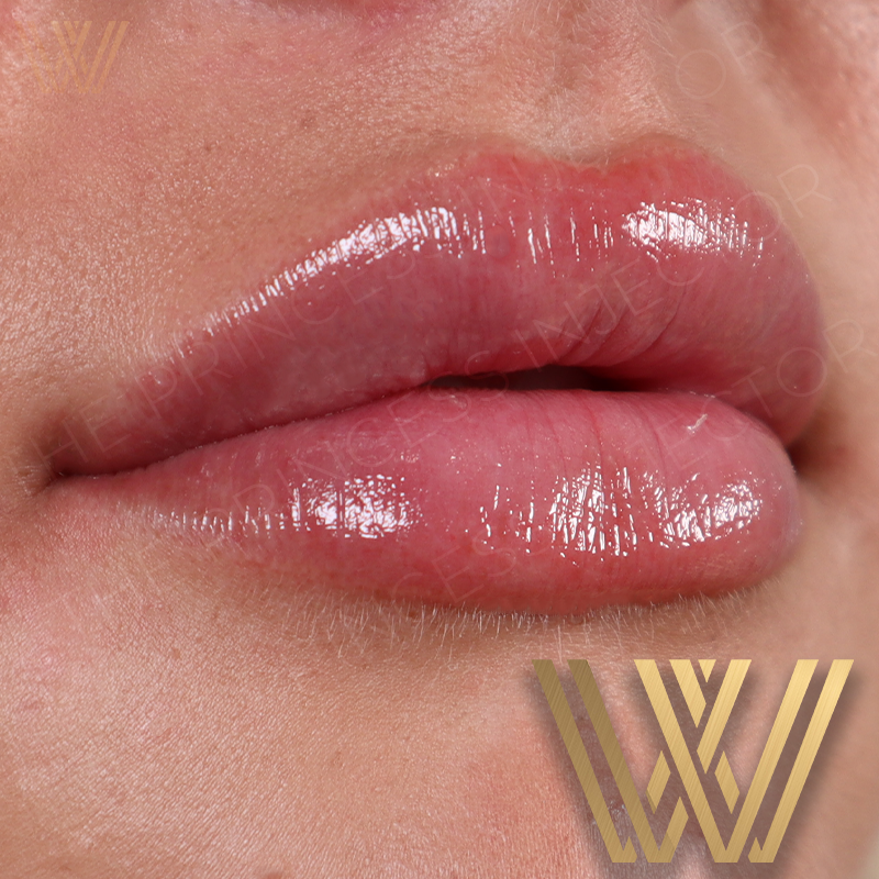 Close-up image of hyaluronic acid lip filler treatment, the MK Pout in Orlando, FL. 