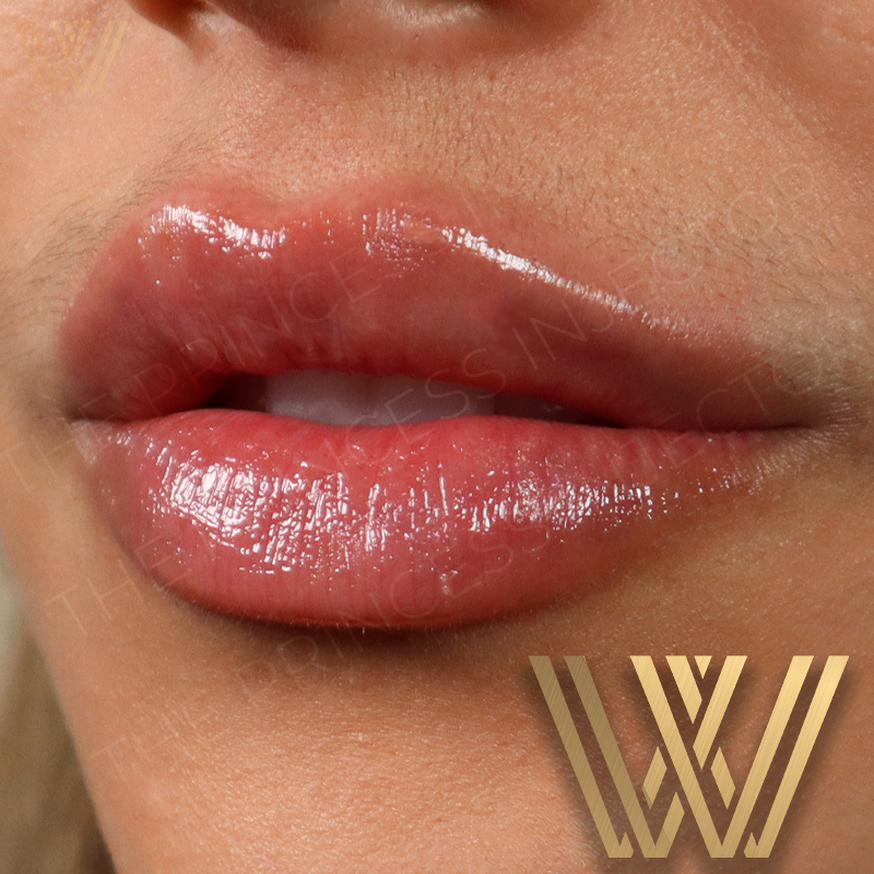 Dermal Fillers in Orlando Achieve Youthful Radiance with Windermere Medical Spa