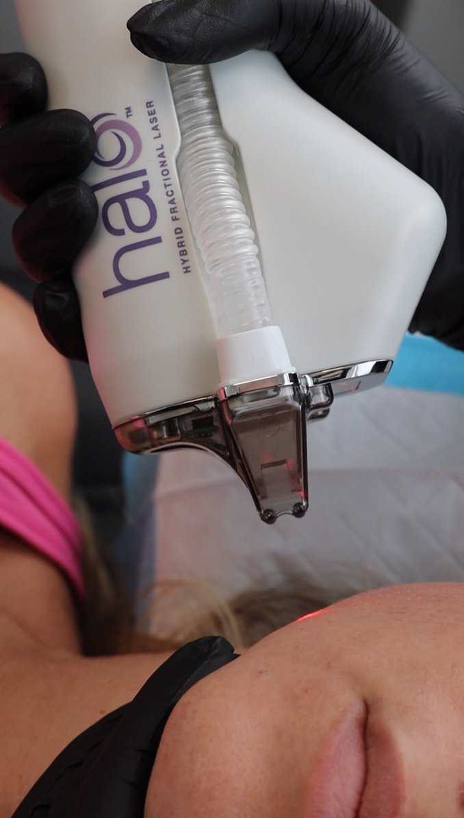 Halo Laser Combined with ProFractional Therapy at Windermere Medical Spa, Orlando, Florida - State-of-the-Art Skin Resurfacing for Optimal Rejuvenation