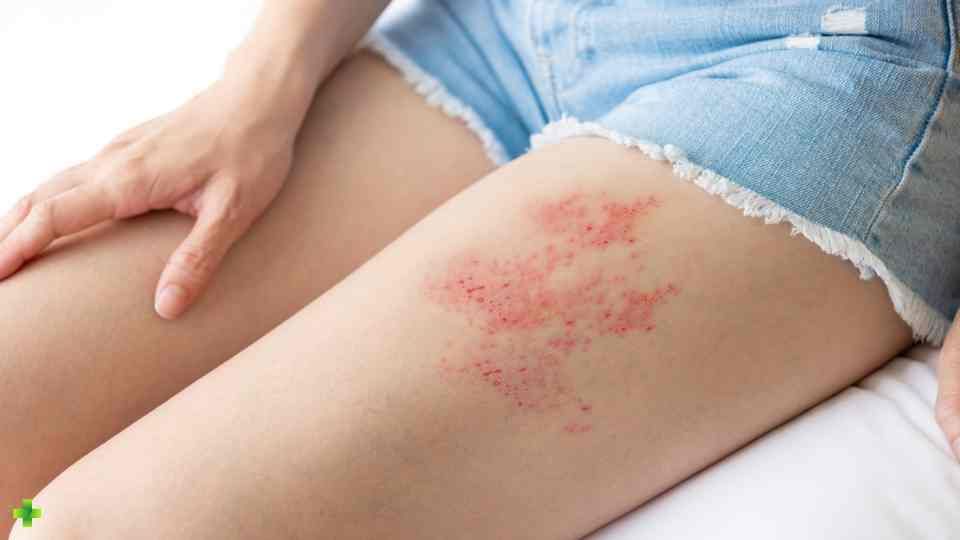 nhs shingles treatment