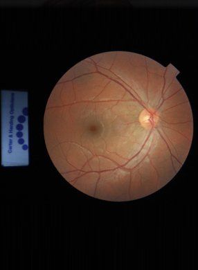 Digital retinal screening