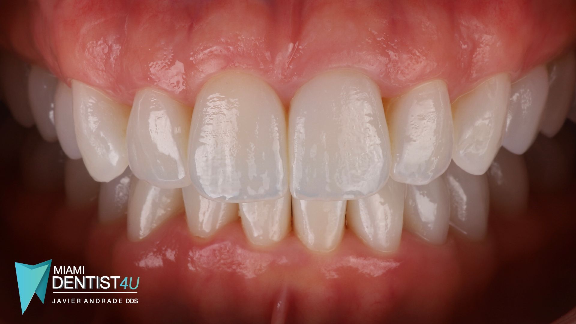 A close up of a person 's teeth with white teeth.