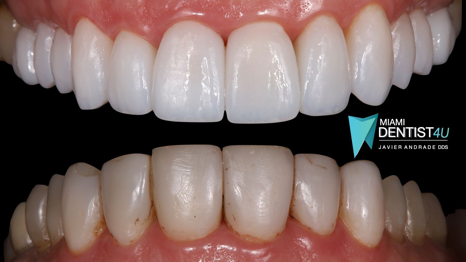 A close up of a person 's teeth with white teeth.